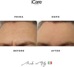 Patch Microaghi Fronte ilare Instant Lifting Technology